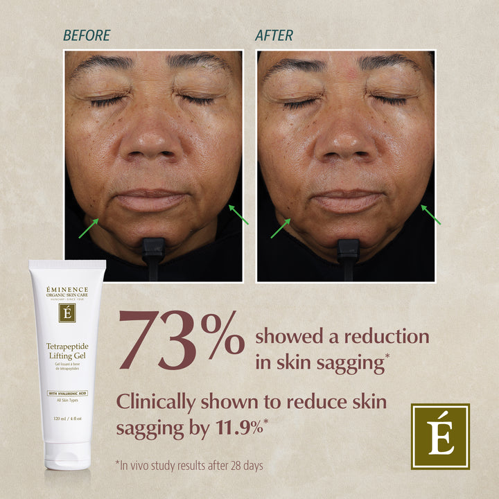 Eminence Organics Tetrapeptide Lifting Gel before and after pictures